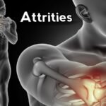 Attrities: Unraveling the Mystery of Joint Pain and Inflammation