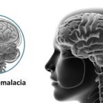 Understanding Encephalomalacia: Symptoms, Causes & Care
